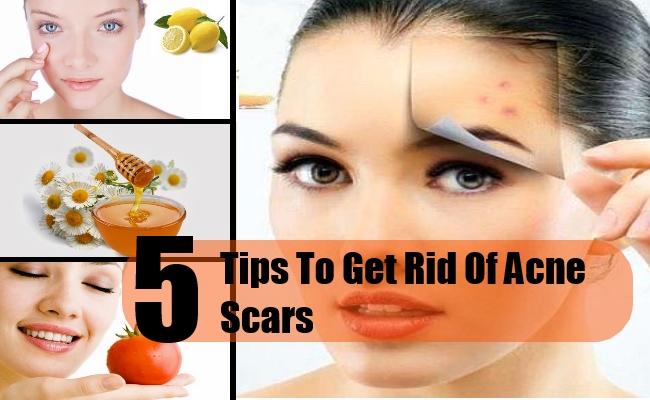 5 Tips For Getting Rid of Acne