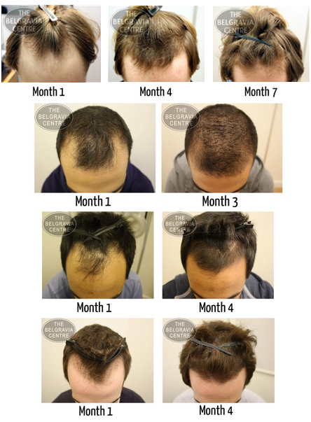 Quit Loss Of Hair and also Grow Back Hair!