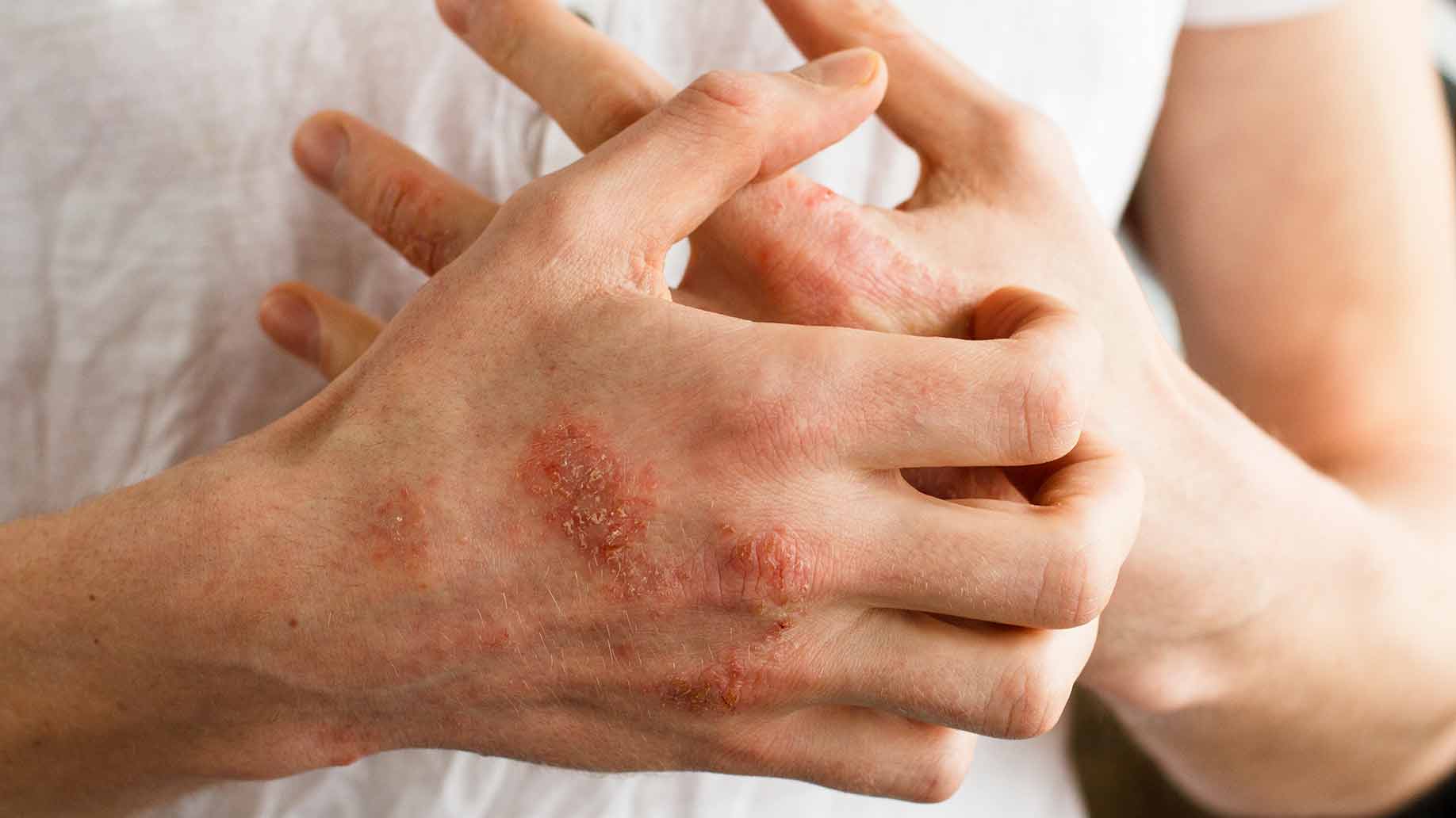 Eczema And The Control Of This Skin Condition