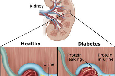Kidney Disease and Diabetes
