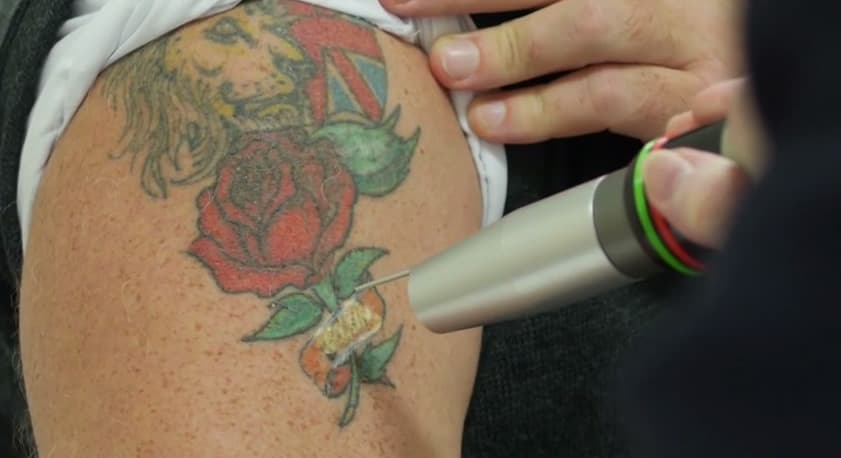 First You Want It, Then You Don’t – Tattoo Removal
