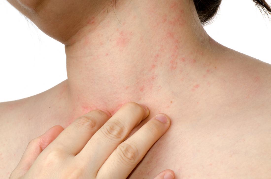 Eczema – What Is It, What Causes It, and How to Treat It