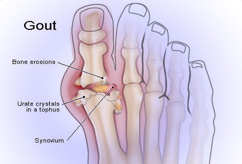 Understanding Gout Attacks