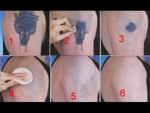Various Ways of Removing Tattoos