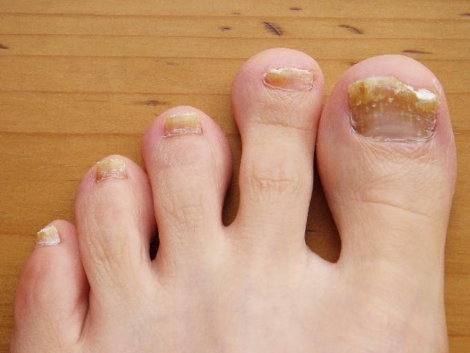 Nail Fungus Infection, Treatment and Prevention