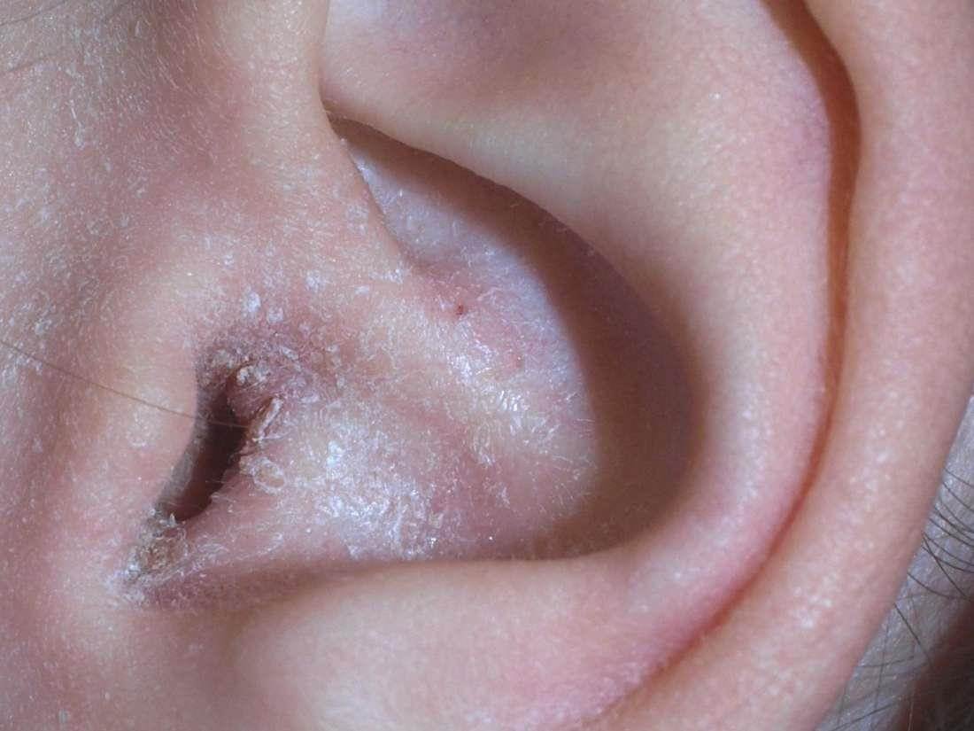 What You Must Know About Yeast Infections in the Ears
