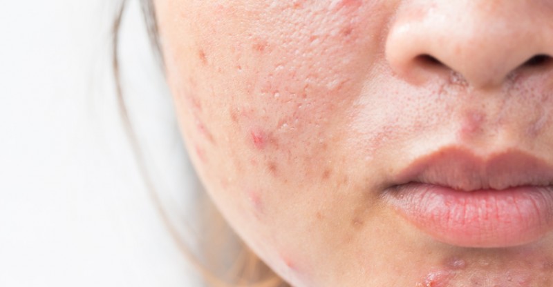 Acne – Getting Rid Of Acne Scars