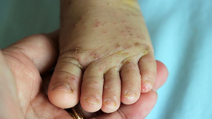 Scabies and Personal Hygiene