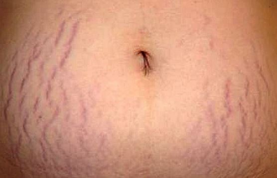 Do Not Let Stretch Marks Invade Your Body