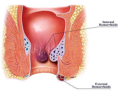 Get Rid Of Your Hemorrhoids With These Great Tips