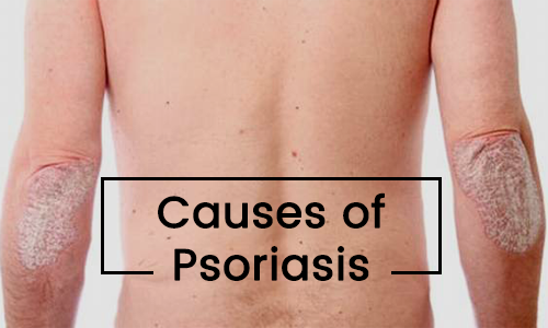 Psoriasis- What Causes Psoriasis?