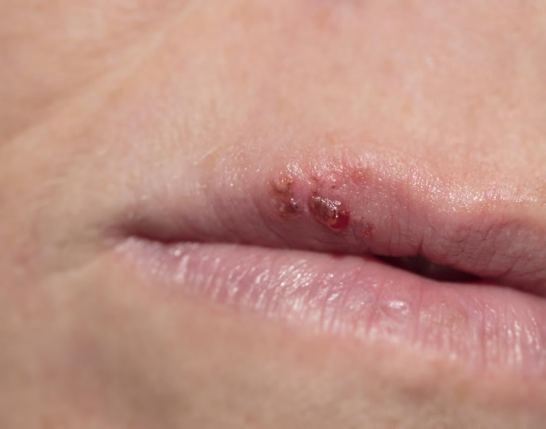 How To Get Rid Of Cold Sores-Tips To Get You On Track