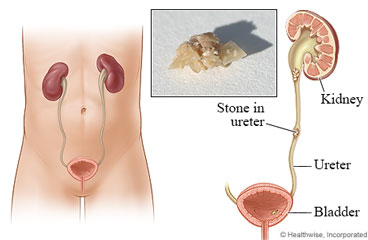 Medical alerts for kidney stones