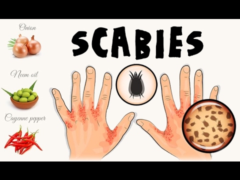 Manuka – A Reliable Natural Cure for Scabies