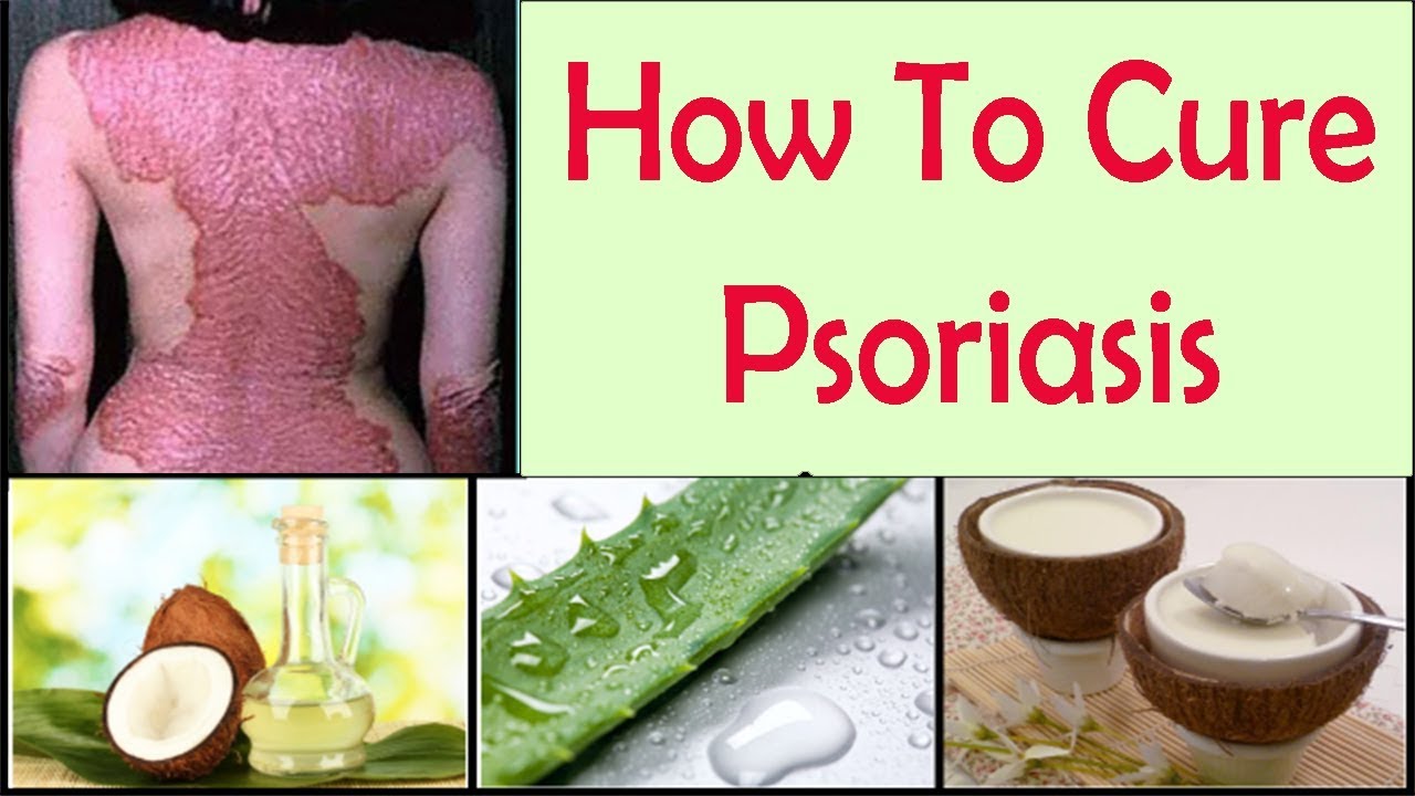 Psoriasis- Relief From Psoriasis