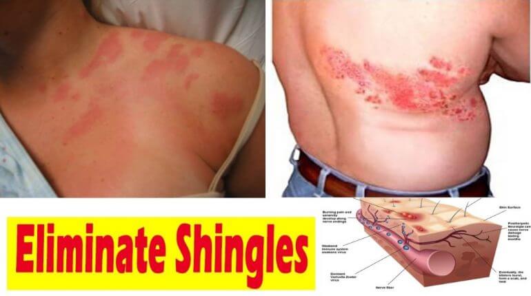 Simple And Fast Shingels Pain Relief