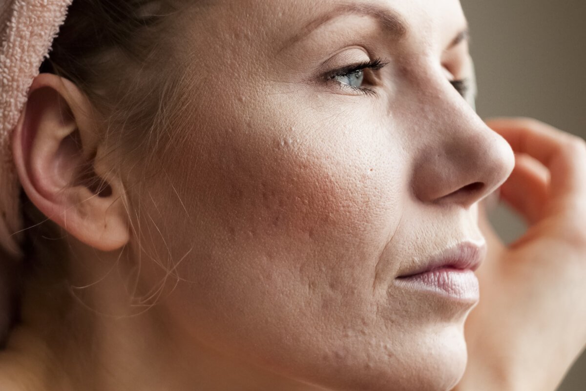 Learnig More About Acne Scars