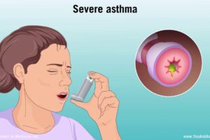 Severe Asthma Medication Treatment Options