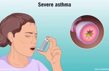 Severe Asthma Medication Treatment Options